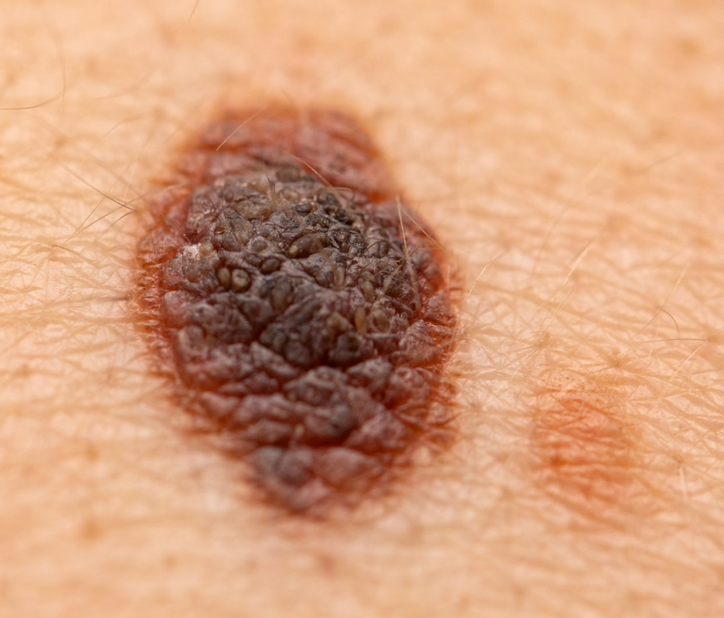 Skin Lesion Classification-logo